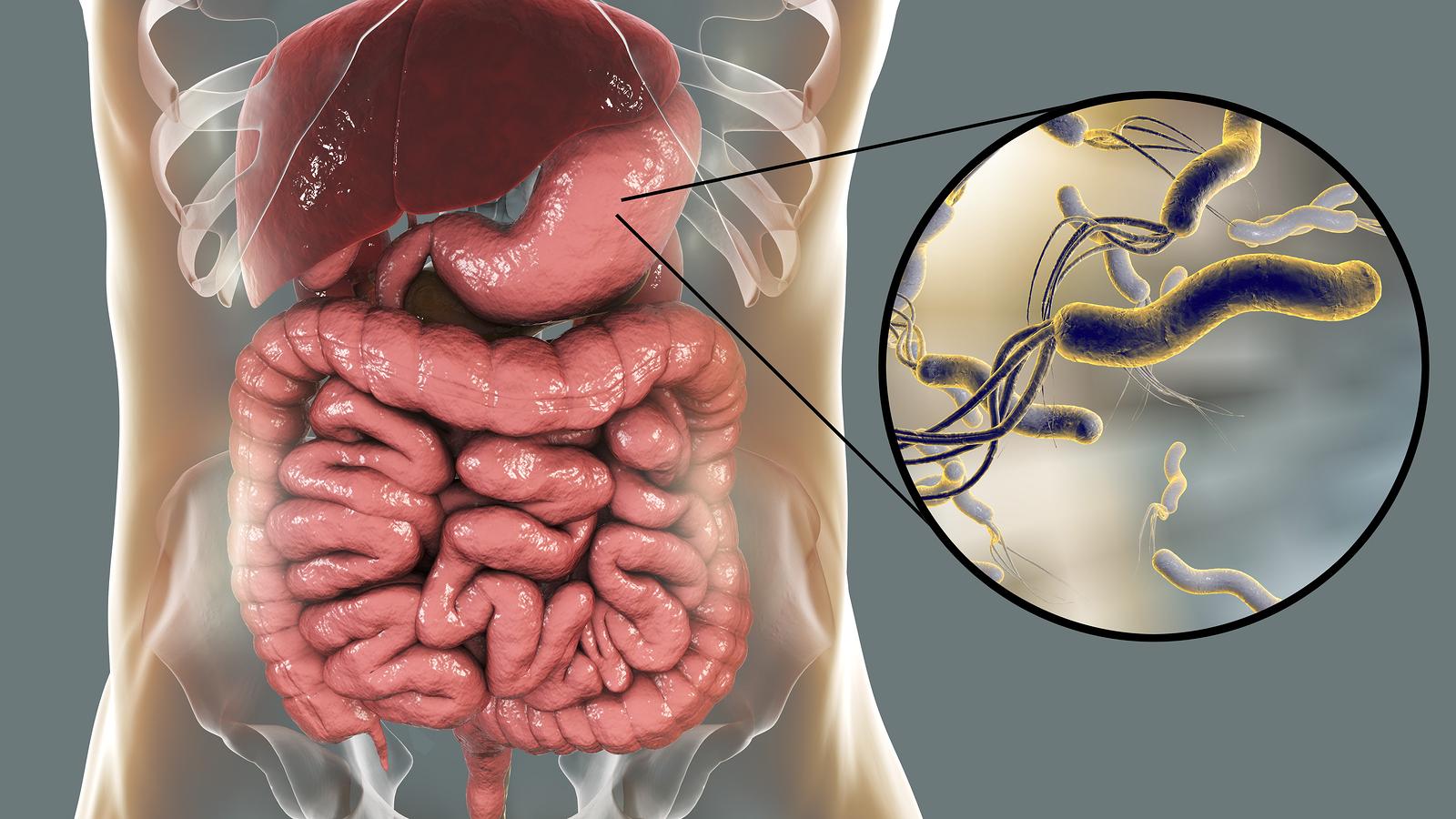 Helicobacter pylori: gut oder böse?