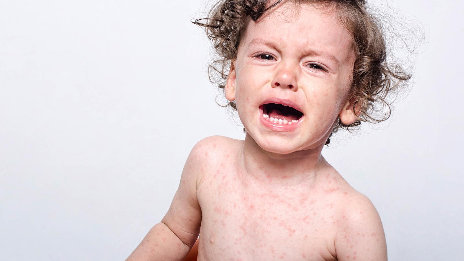 Wie entstehen Masern?