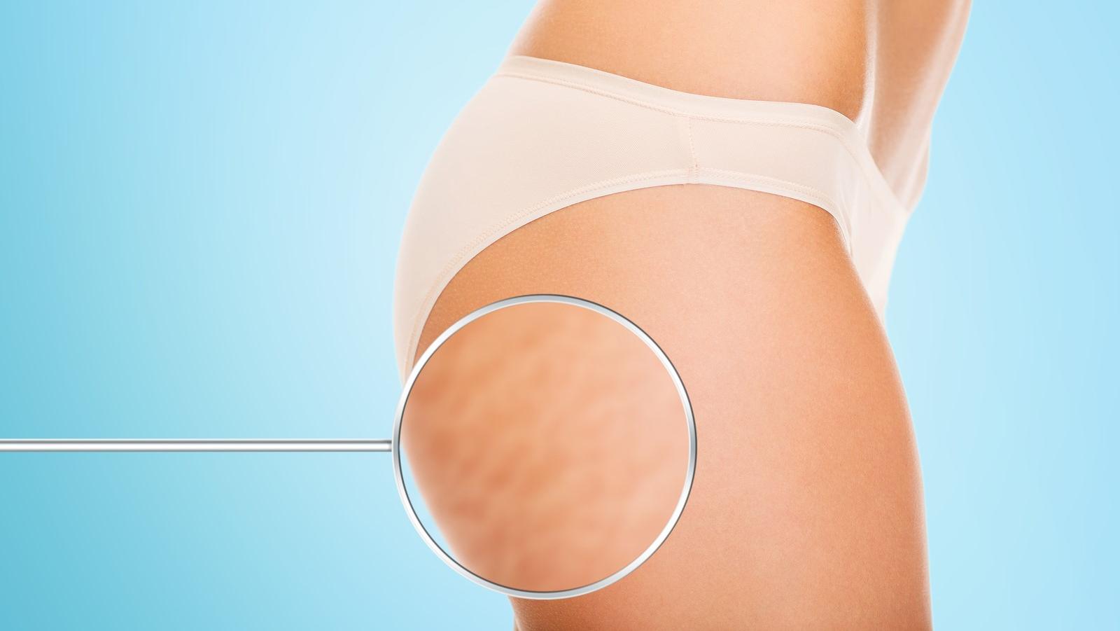 Tipps gegen Cellulite