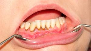 Zahnfleischentzündung: kann sogar zum Verlust der Zähne führen